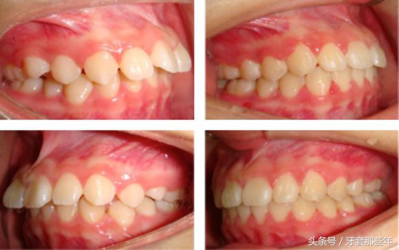 戴牙套矫正要打骨钉吗,矫正先拔牙还是先戴牙套