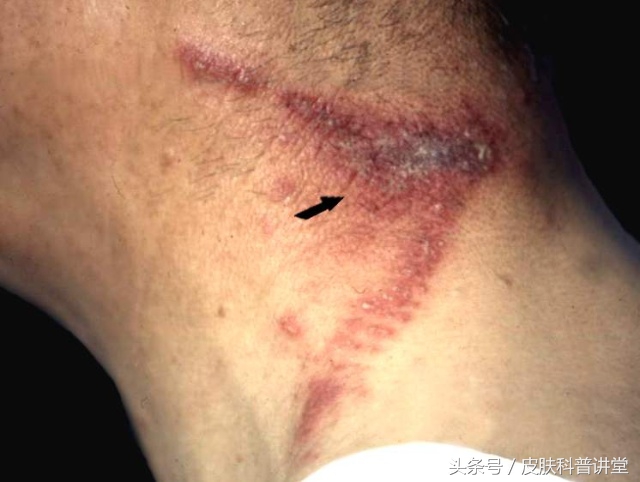 隐翅虫皮炎部位睡觉需要避开吗,晚上睡觉怎么避免隐翅虫