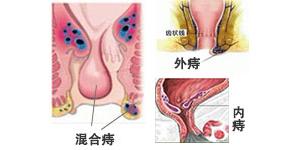抽烟和喝酒哪个对痔疮危害大,痔疮时间久了不割会有哪些危害