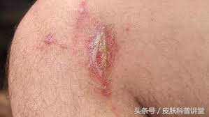 隐翅虫皮炎部位睡觉需要避开吗,晚上睡觉怎么避免隐翅虫