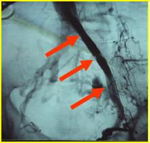 下肢肿胀有效的治疗手段是什么？