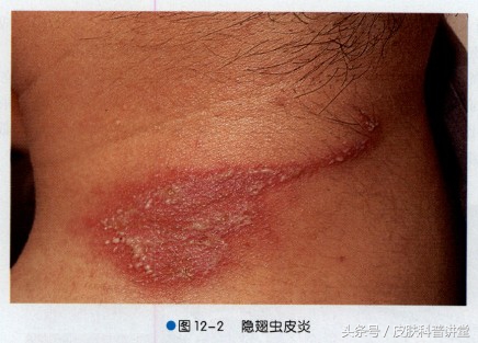 隐翅虫皮炎部位睡觉需要避开吗,晚上睡觉怎么避免隐翅虫