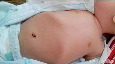 宝宝有肋骨外翻怎么办,宝宝肋骨外翻怎么办