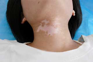 白癜风早期会有小米粒疙瘩吗,儿童白癜风早期治愈率90%