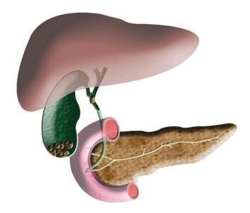 癌症术后一年内又复发,癌症手术后一年死亡