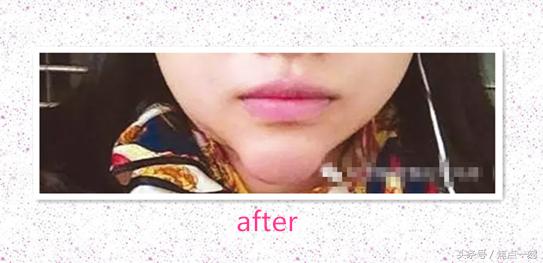 垫下巴之后感觉嘴扁,垫下巴垫歪了能用玻尿酸矫正吗