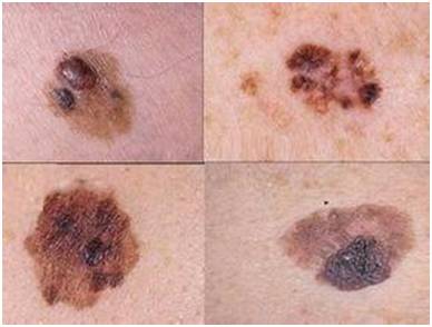 如何判断身上的痣有没有癌变,小孩身上有痣能癌变吗