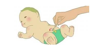 小儿脐疝脐带四周会鼓起吗,新生儿腹股沟脐疝如何用硬币按压