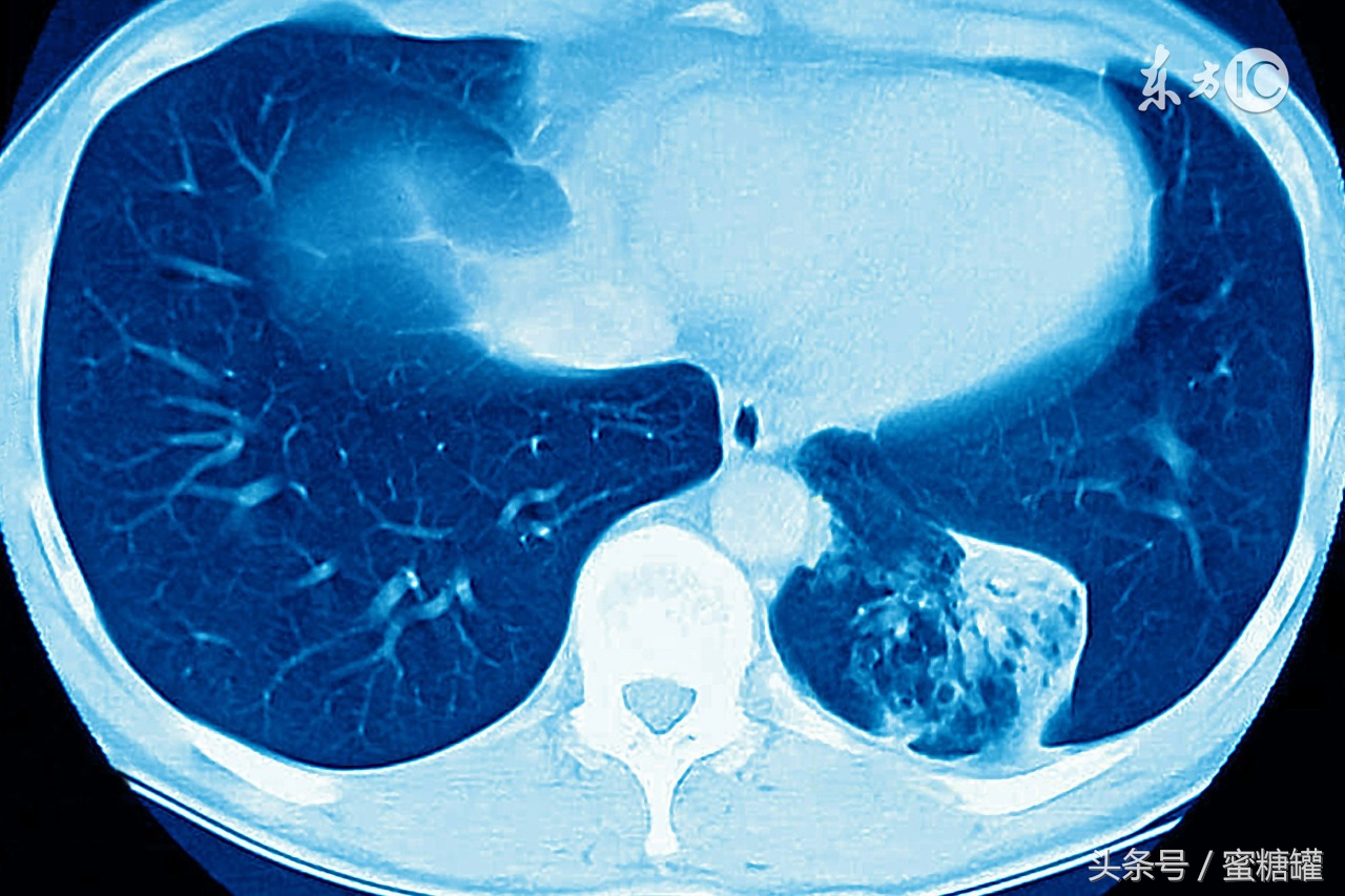 早期淋巴结癌症什么症状,舌癌症的早期症状及表现