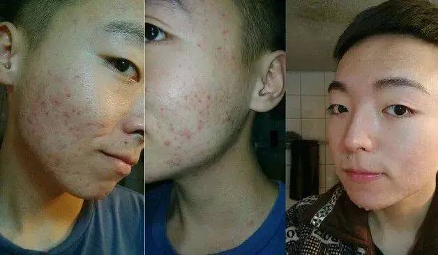 黑头粉刺满是痘痘,粉刺和痘痘肌的区别