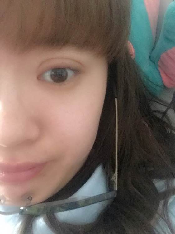 全切双眼皮一个月还是肿怎么回事,全切双眼皮一个月还肿是怎么回事