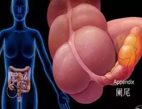 怀孕四个月了查出阑尾炎,怀孕了得了阑尾炎怎么办