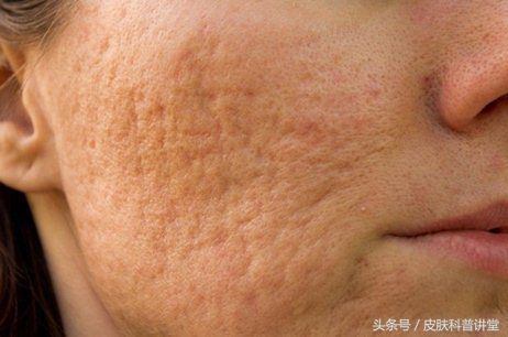 果酸焕肤精华液与果酸的区别,什么样的人需要果酸换肤