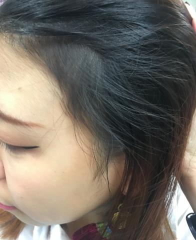 为什么没人敢去植发,为什么很多人都没有去植发