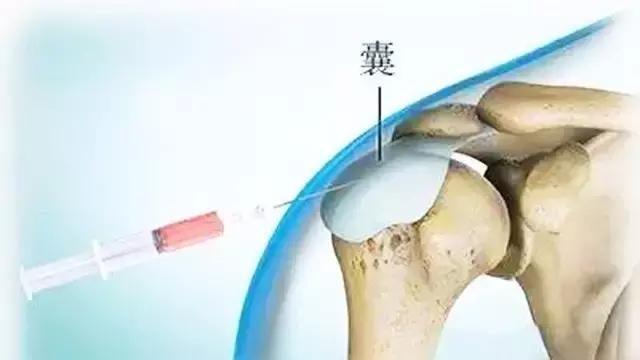 打封闭针，是暂时缓解还是能根治？