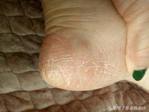 脚部粗糙干裂怎么办 (脚干裂一招搞定)