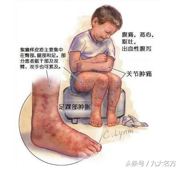 色素性紫癜性皮肤病中医治疗,中医治疗紫癜性皮肤炎有效么