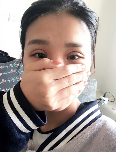 割双眼皮一个月效果,40岁割双眼皮效果好不