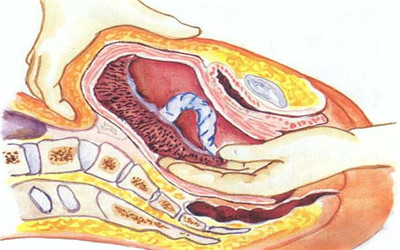 刻骨铭心的经历永生难忘,手动剥胎盘的经历