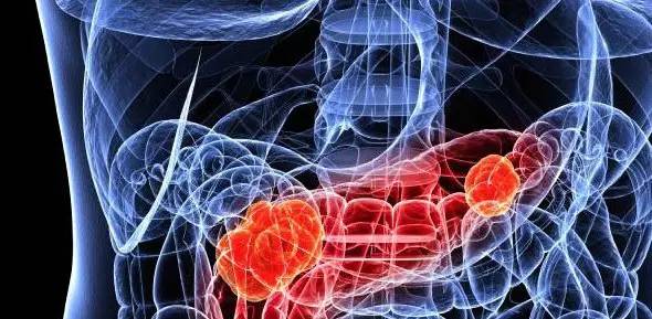 在澳洲医院治疗癌症,在澳洲看病有多难