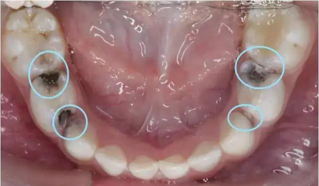 小孩子换牙要去看牙医吗,孩子换牙期一定要拔牙吗
