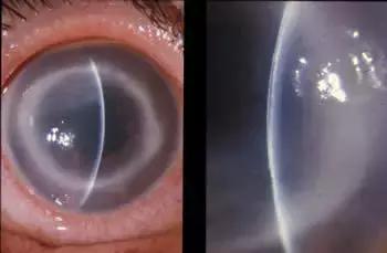 戴隐形眼镜洗手没有洗手液,隐形眼镜被水泡过不好戴了