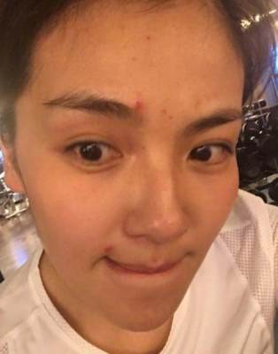 长痘憋怕有涛姐陪着你呐