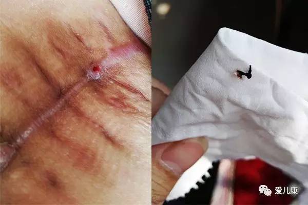 剖腹产刀口有线头露出来怎么处理,剖腹产后刀口有凸出来的疤痕