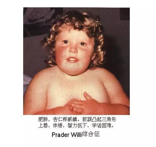 罕见病儿童时期发病,究竟罕见病孩子应该治疗还是放弃