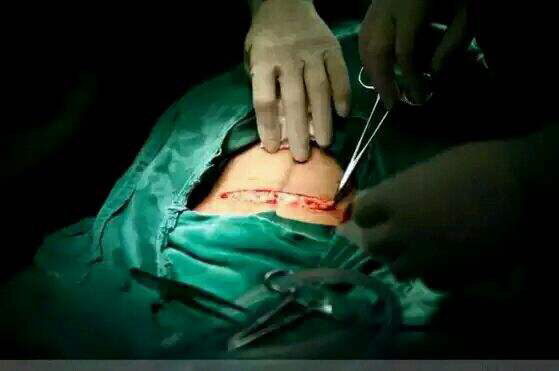 剖腹产对孕妇有多大伤害,剖腹产对孕妇好还是顺产好