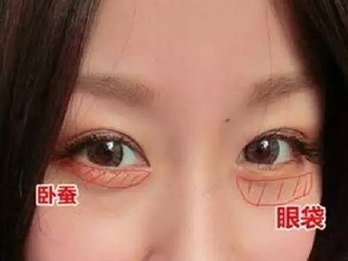 怎样区分眼袋卧蚕和双眼皮,怎样区分卧蚕和眼袋最简单的方法