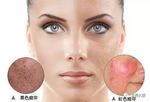 挤痘上瘾怎么办？用这些方法让你再不怕痘痕痘坑！