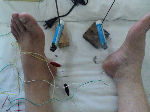 足跟痛为什么反复发作难治愈,足跟底疼痛的原因和治疗方法