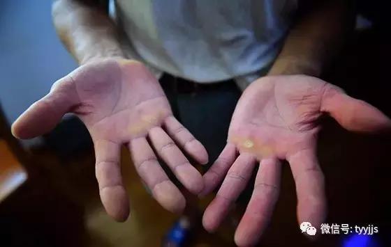 健身人的手掌老茧怎么恢复,手上老茧是怎么形成的