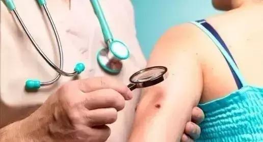 黑痣的危险部位,如何才能避免产生黑痣