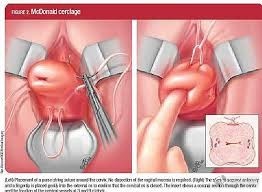 23周宝宝，脚已经掉出来，还能塞回去安胎吗？