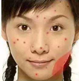 脸的侧面为什么长一些小痘痘,为什么额头上长了好多痘痘