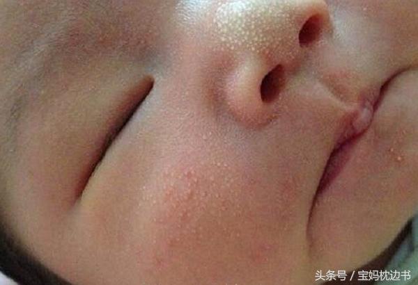 怎么判断是湿疹还是粟粒疹,宝宝湿疹丘疹