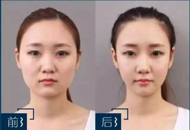 瘦脸针都拯救不了的大饼脸,瘦脸针不能一劳永逸吗