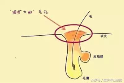 皮肤泛油毛孔粗大用什么面膜清洁,毛孔粗大脸上泛油如何改善男生