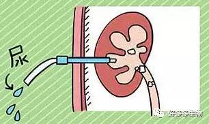 肾积水引发的尿漏怎么办,肾积水排尿困难吃什么药