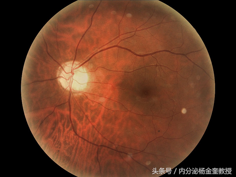 治疗糖尿病新型产品,糖尿病视网膜病变的全科医学防治