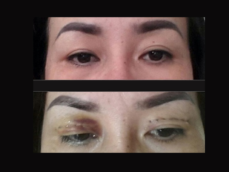 上住家‘美容院’缝眼皮致红肿越南妇索赔被拒怒报警