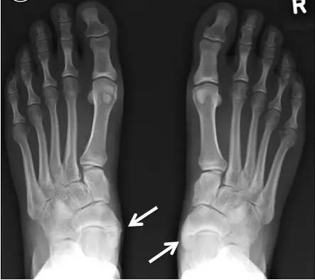 踝关节疼痛病因病机,踝关节伤病