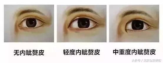 做出来的双眼皮和天然双眼皮区别,怎么样做的双眼皮才是最成功的