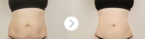 什么是腰腹抽脂,什么叫抽脂腰腹