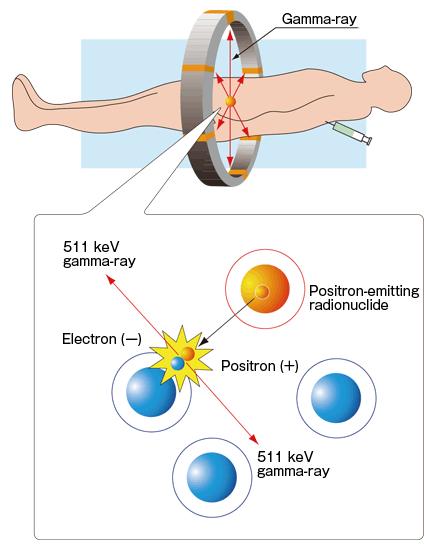什么是ect肺通气显像,什么是ect