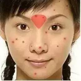 为什么长闭口粉刺痘痘还总是反复,痘痘反复长你知道是为什么吗