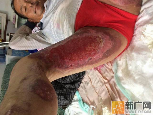 彝族村民李增贵烤贾酒盼脱贫遇火灾，栽多少包谷才能抚平49%烧伤