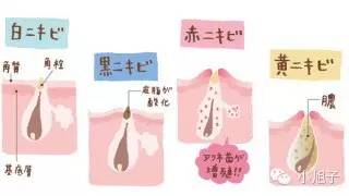 抗痘和细致毛孔,美肌抗痘大作战